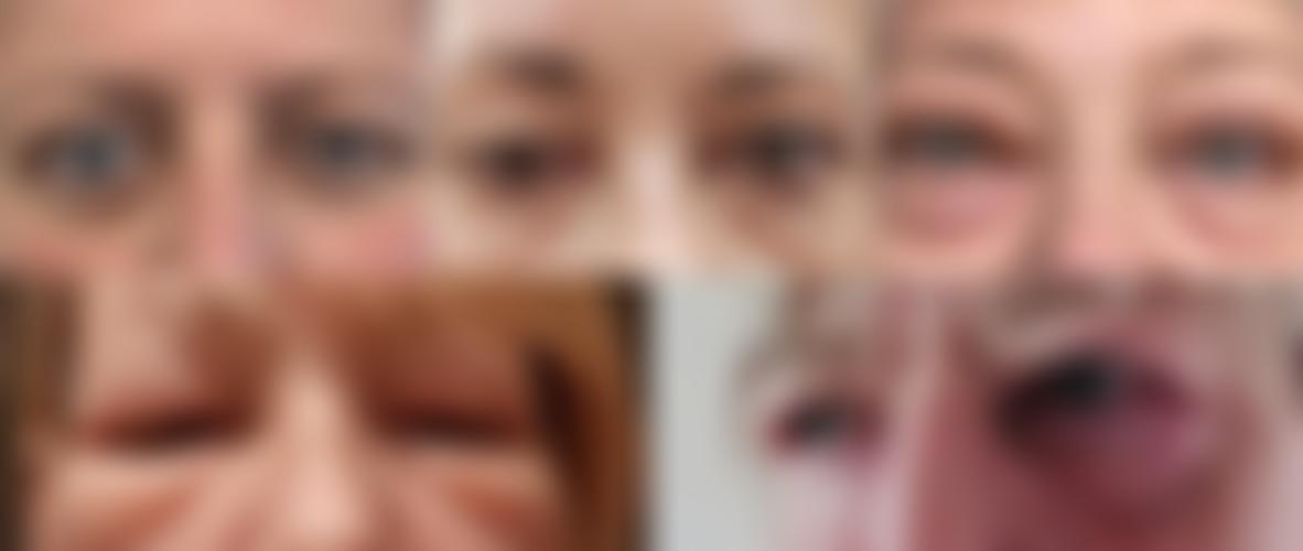 Thyroid Eye Disease Charitable Trust | Charici